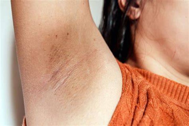 6 causes of underarm rashes and how to avoid irritating your armpits